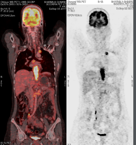 pet ct scan in Nepal